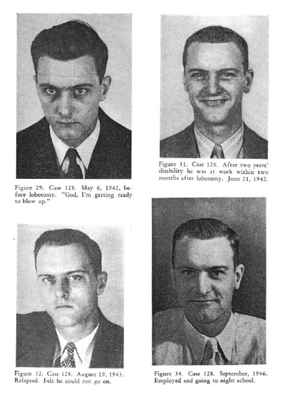 before and after lobotomy - Figure 29, Case 128. , be foce lobotomy. "God, I'm getting ready to blow up." Figure 31. Case 128. After two years' disability he was at work within two months after lobotomy. . Figure 12. Ca 128. Aug Relapsed Fels he could not